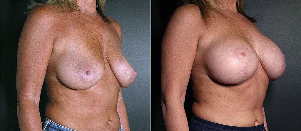 Breast Augmentation Before & After