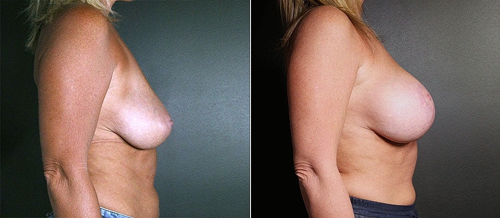 Breast Augmentation Before & After