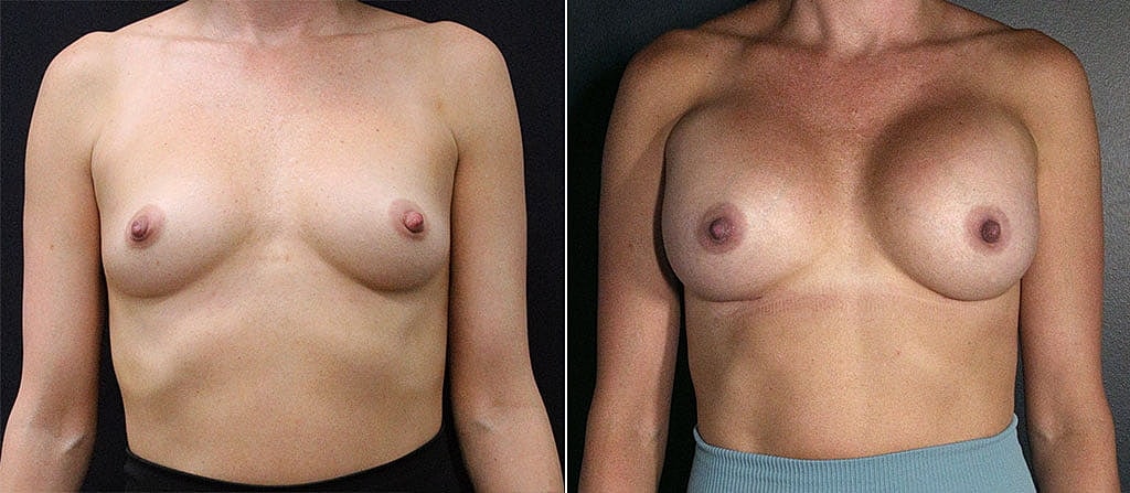 Breast Augmentation Before & After