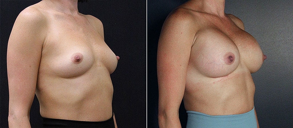 Breast Augmentation Before & After