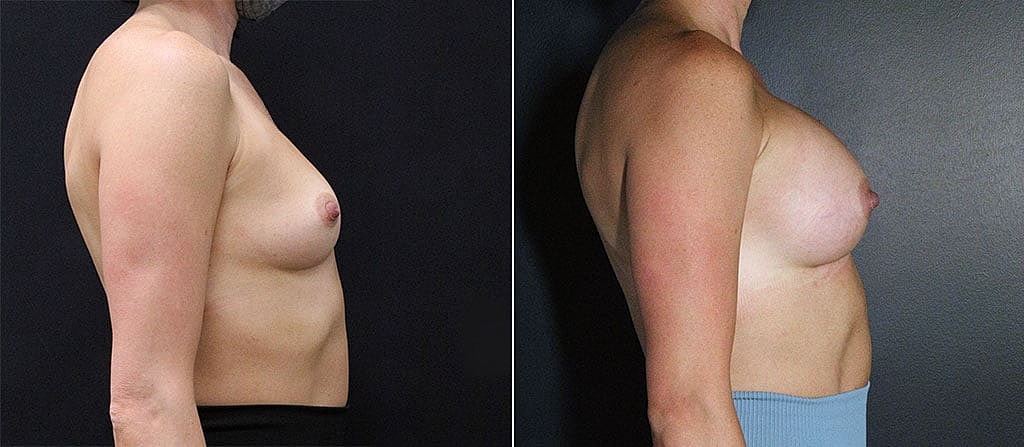 Breast Augmentation Before & After
