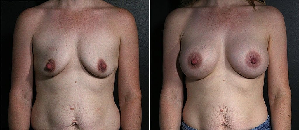 Breast Augmentation Before & After