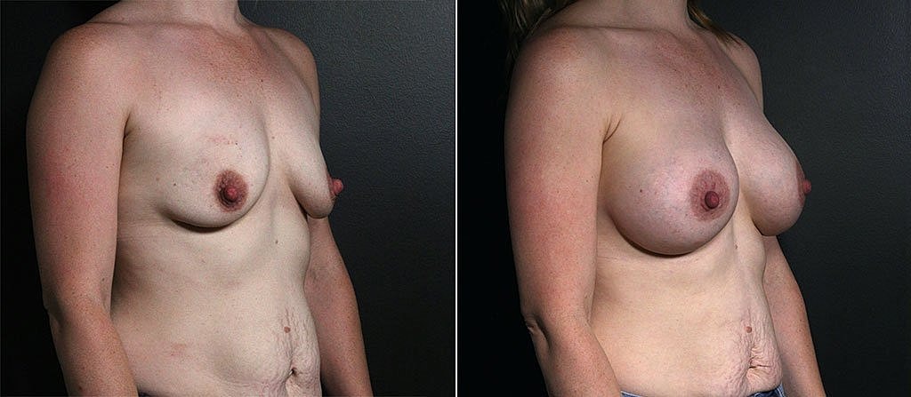 Breast Augmentation Before & After