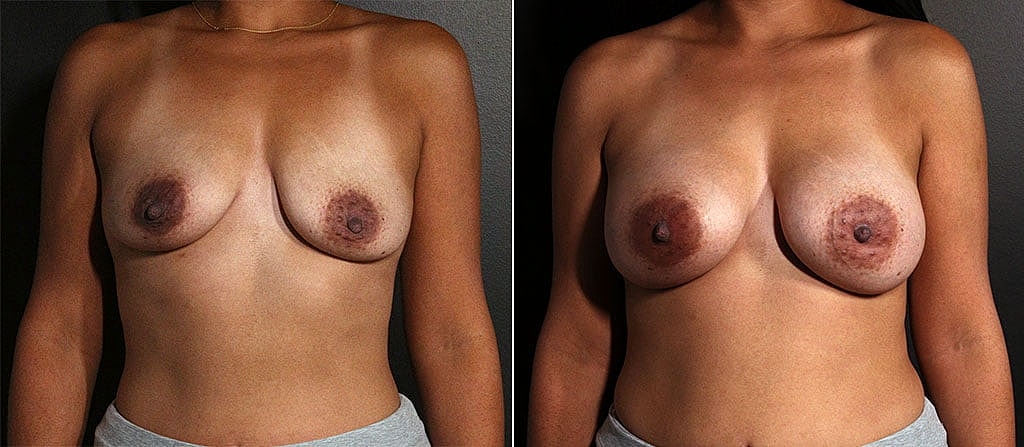 Breast Augmentation Before & After