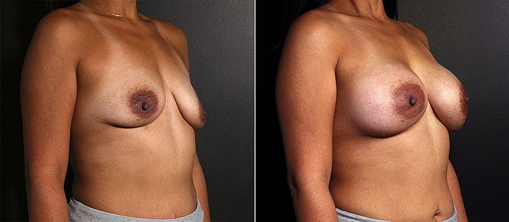 Breast Augmentation Before & After