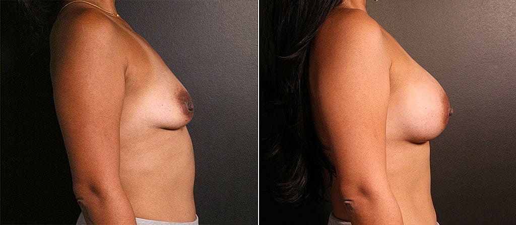 Breast Augmentation Before & After