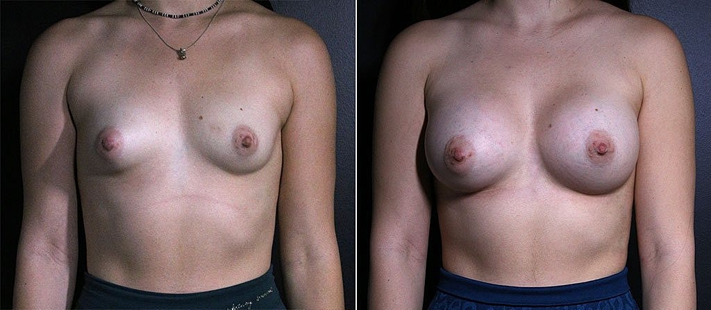 Breast Augmentation Before & After