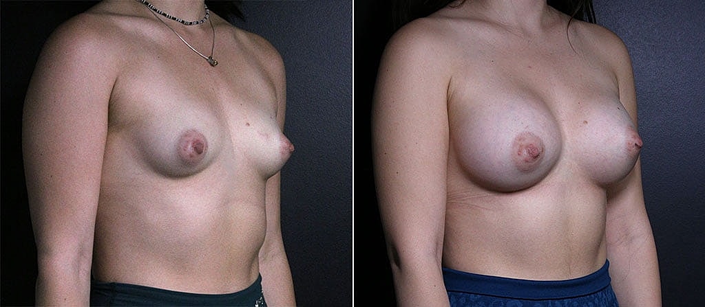 Breast Augmentation Before & After