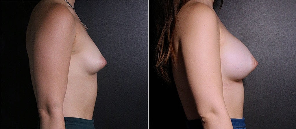 Breast Augmentation Before & After