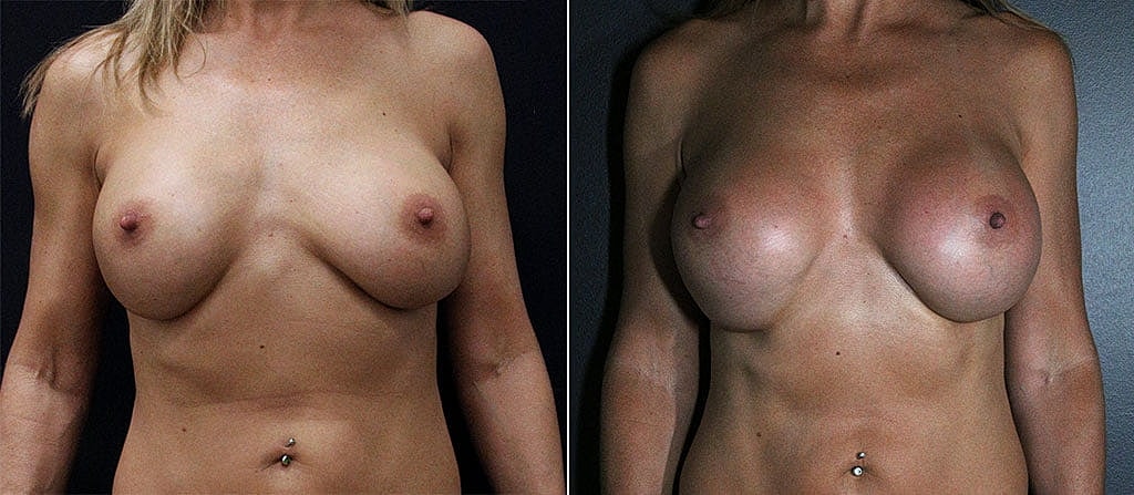 Breast Augmentation Before & After