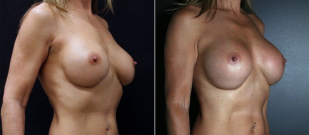 Breast Augmentation Before & After