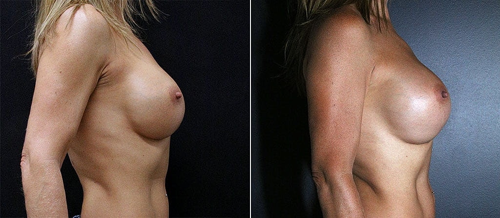 Breast Augmentation Before & After