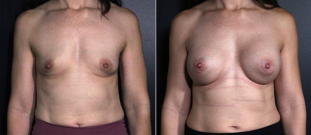 Breast Augmentation Before & After