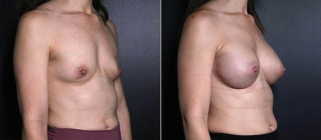 Breast Augmentation Before & After