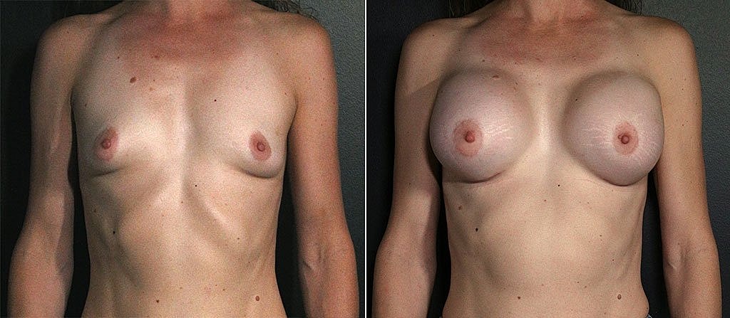 Breast Augmentation Before & After