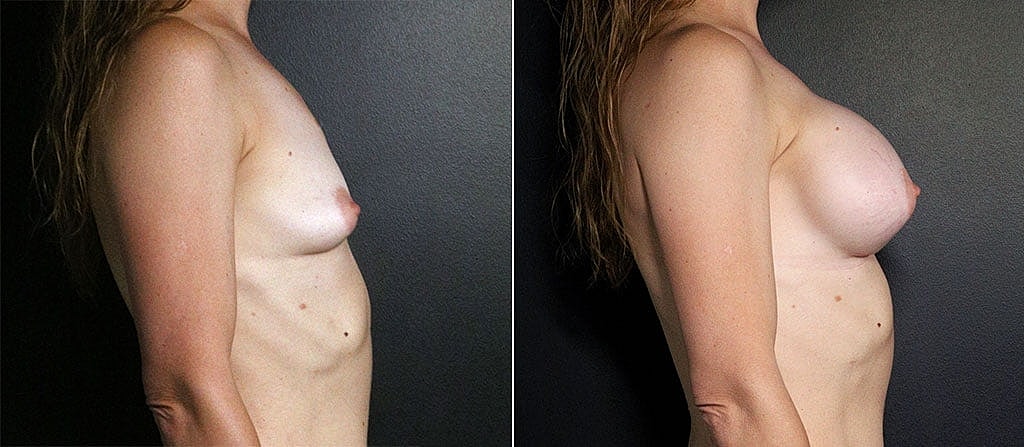 Breast Augmentation Before & After