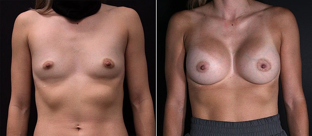 Breast Augmentation Before & After