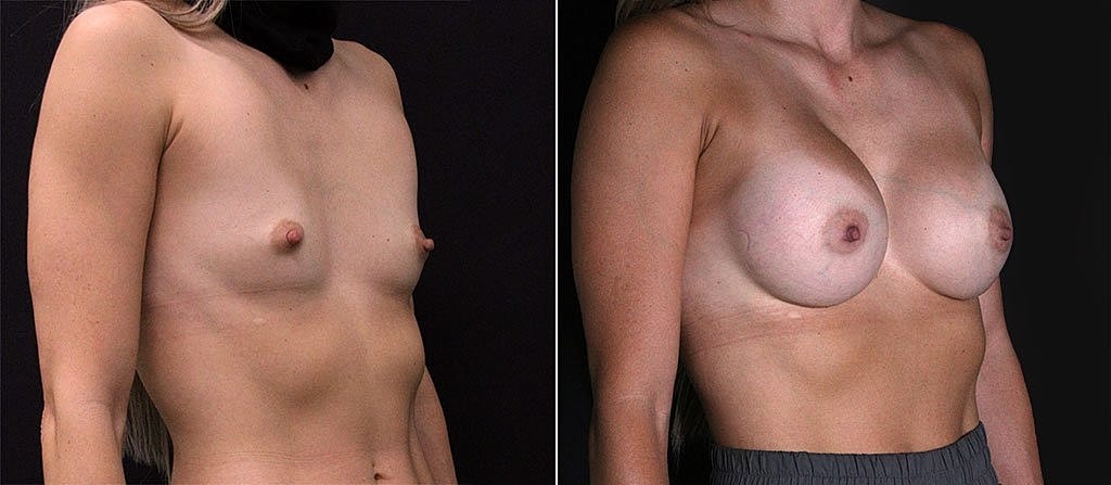 Breast Augmentation Before & After