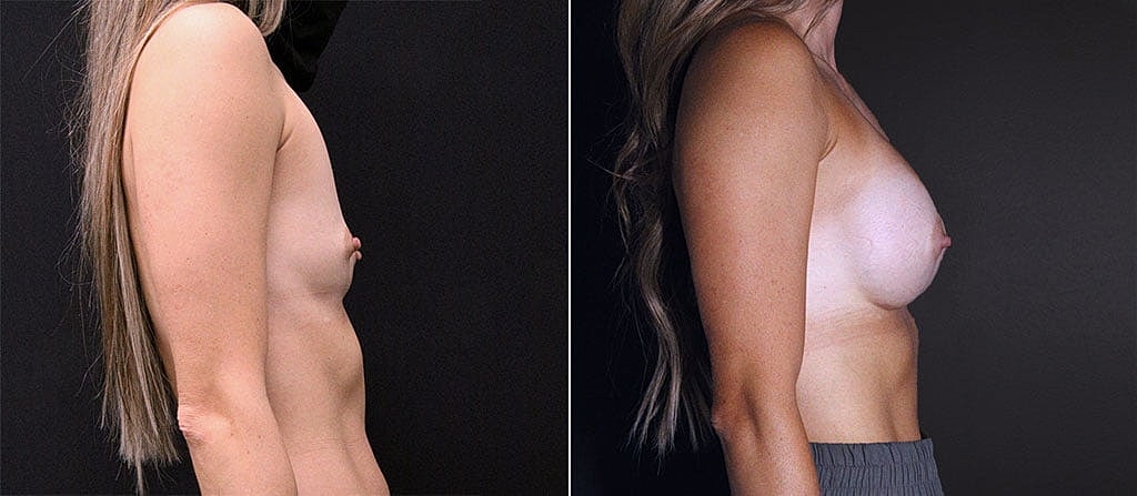 Breast Augmentation Before & After