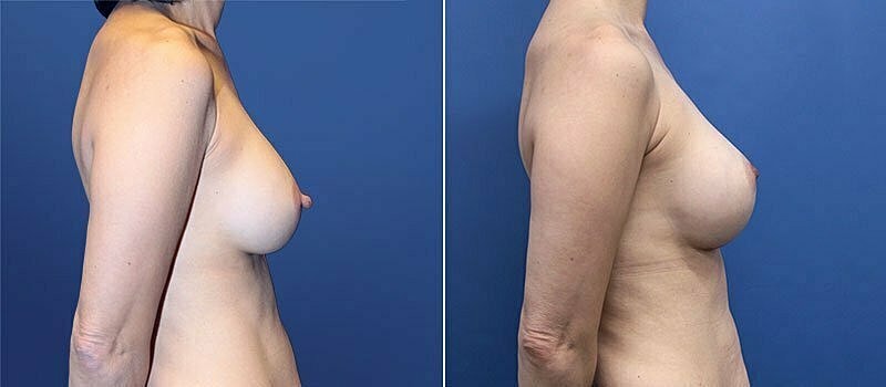 Breast Augmentation Before & After