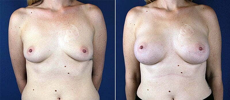 Breast Augmentation Before & After