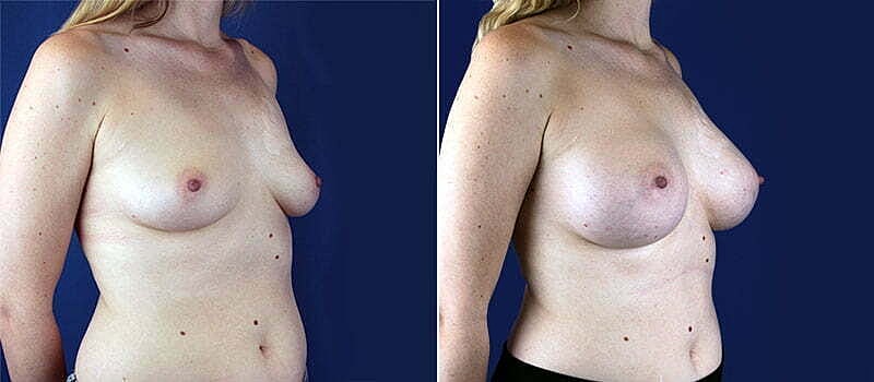 Breast Augmentation Before & After