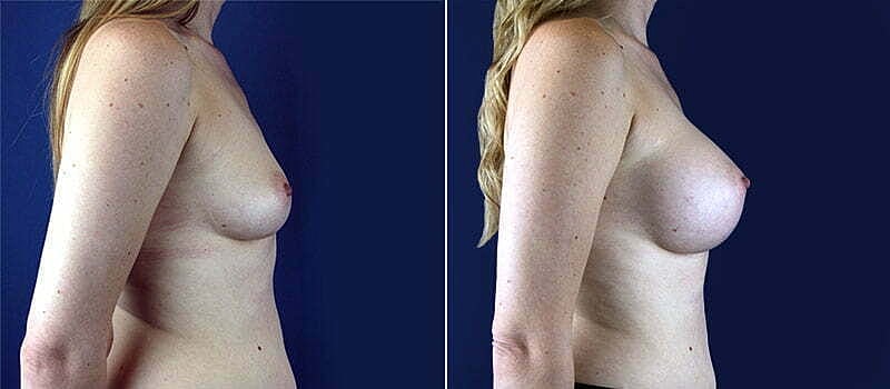 Breast Augmentation Before & After