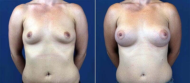 Breast Augmentation Before & After
