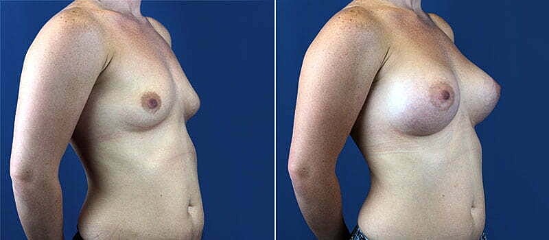 Breast Augmentation Before & After