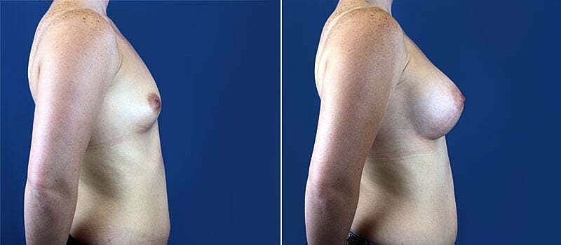Breast Augmentation Before & After