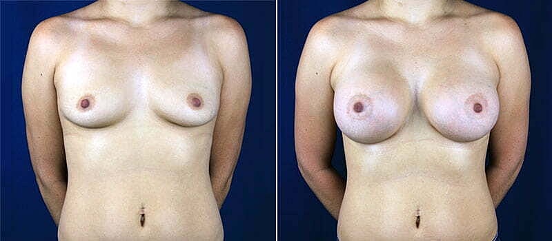 Breast Augmentation Before & After