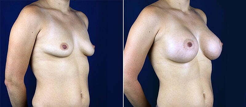Breast Augmentation Before & After