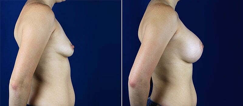Breast Augmentation Before & After