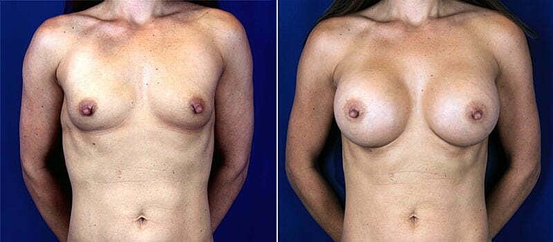 Breast Augmentation Before & After