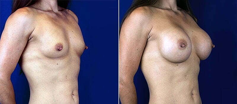 Breast Augmentation Before & After