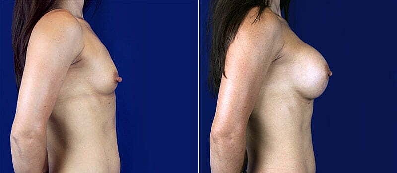 Breast Augmentation Before & After