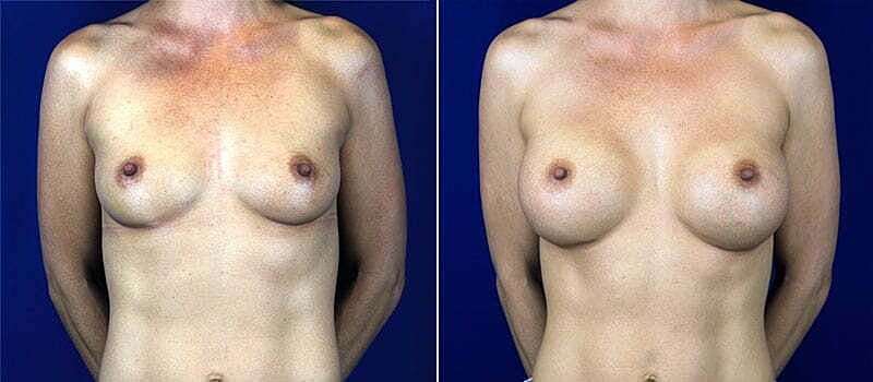 Breast Augmentation Before & After
