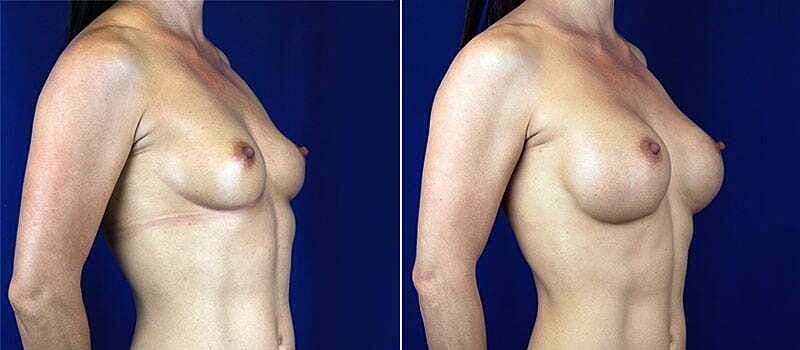 Breast Augmentation Before & After