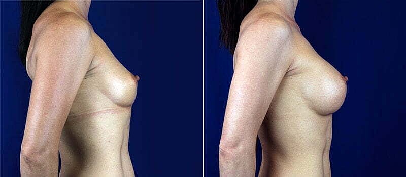 Breast Augmentation Before & After