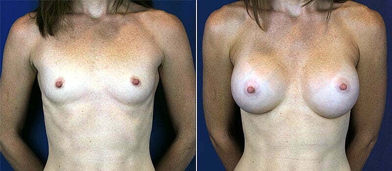 Breast Augmentation Before & After