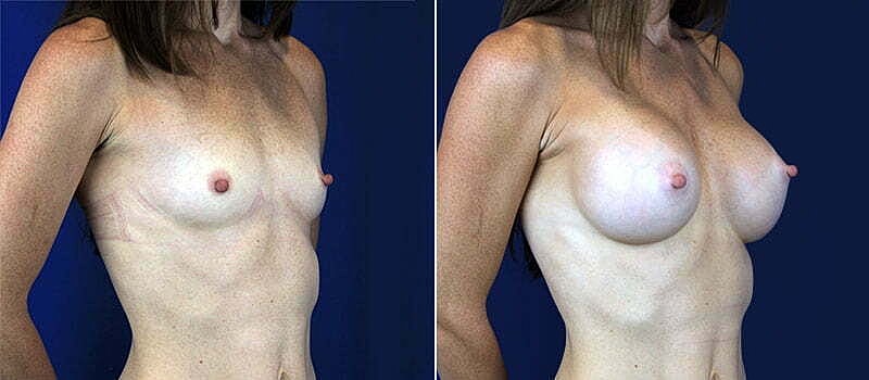 Breast Augmentation Before & After