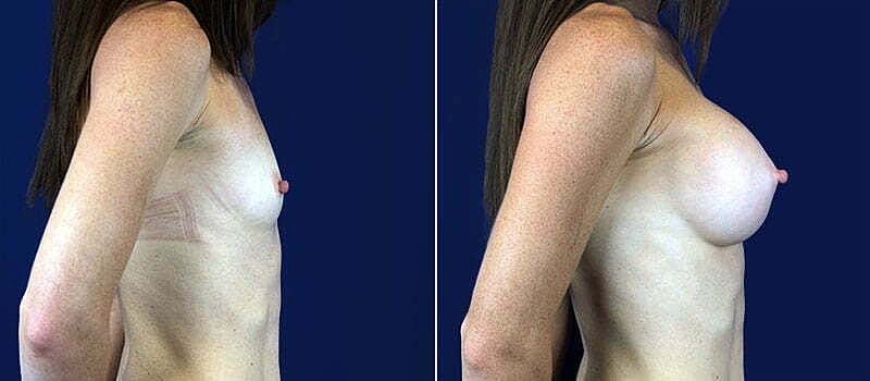 Breast Augmentation Before & After