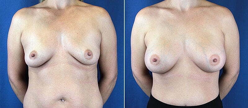 Breast Augmentation Before & After