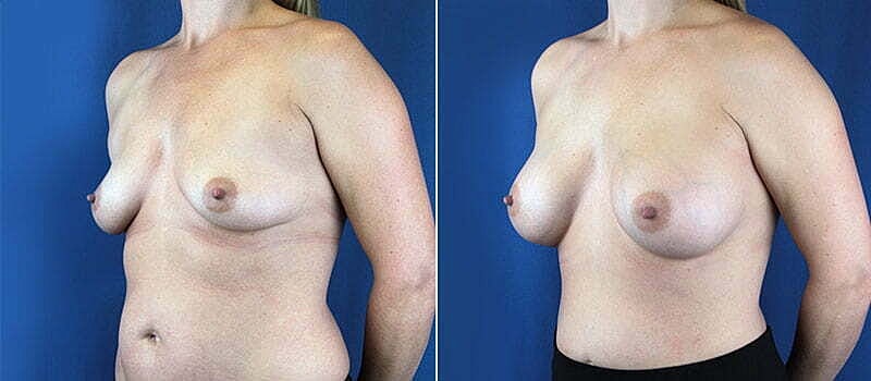 Breast Augmentation Before & After