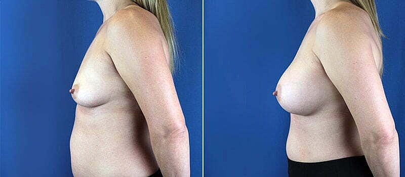 Breast Augmentation Before & After