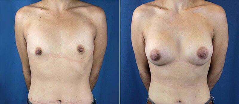 Breast Augmentation Before & After