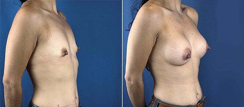 Breast Augmentation Before & After