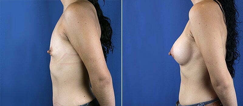Breast Augmentation Before & After