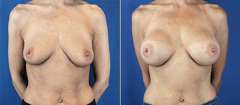 Breast Augmentation Before & After