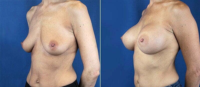 Breast Augmentation Before & After
